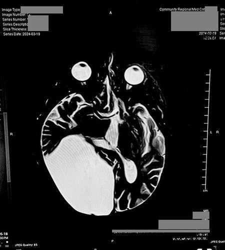 A Life-Changing Moment After a Brain Cyst Diagnosis